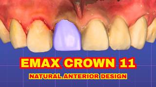 Emax Full Crown 11 Natural Anterior Design In Exocad Step-By-Step Tutorial