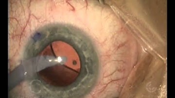 DMEK Triple Procedure