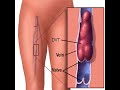 Blood Clots vs. Sciatica! You Must Know How to Tell the Difference or Risk Killing the Patient!