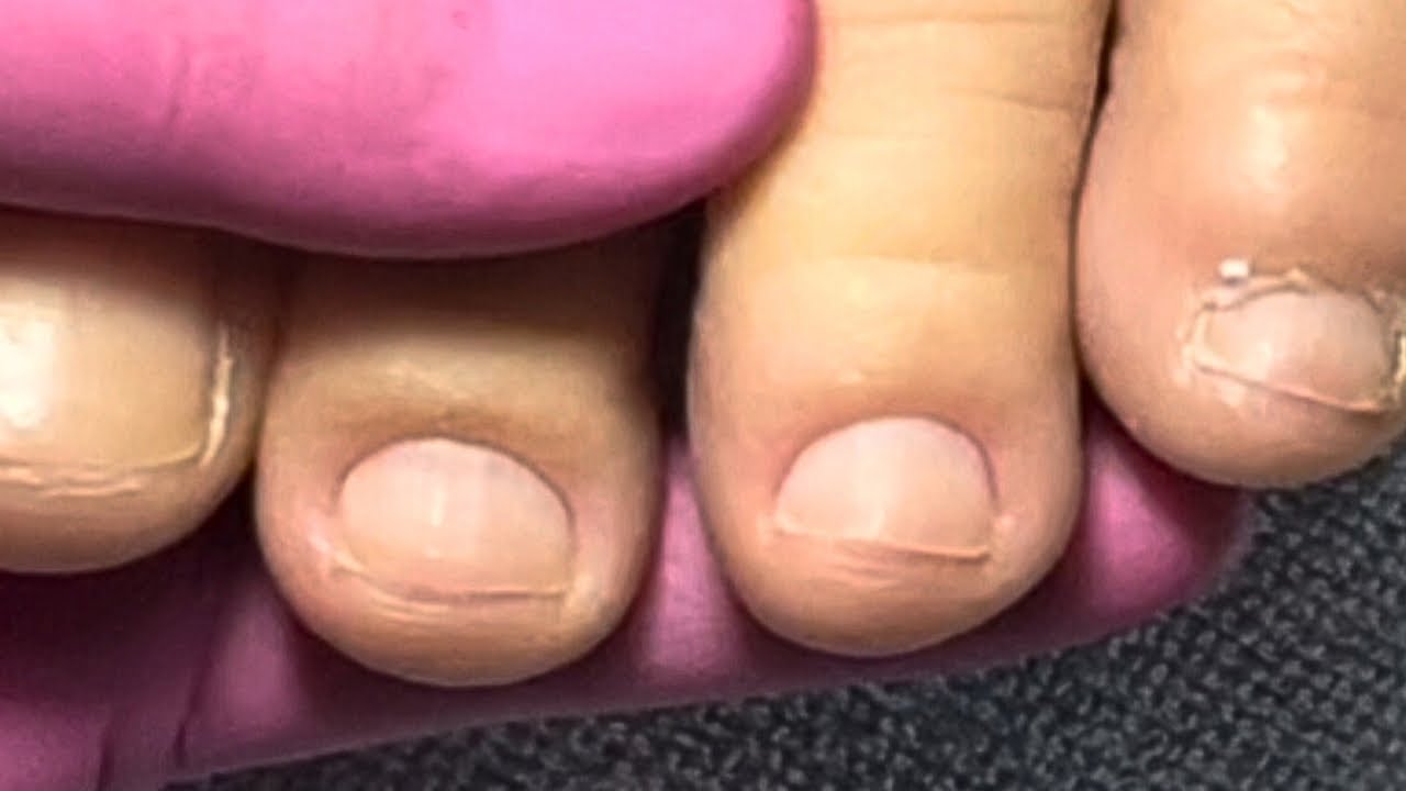 Passo a Passo da Cutilagem Profunda nos Pés: Guia Ideal para Iniciantes!