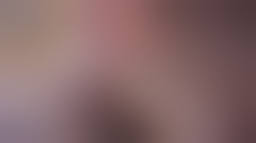 Laparoscopic Liver Metastasectomy . seg V.