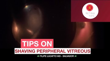 Tips on: Shaving peripheral vitreous