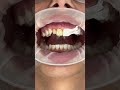 How new veneers are made shorts veneers  cosmeticdentistry