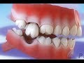 गिरने वाले दांत - उनका इलाज न करने के परिणाम ©