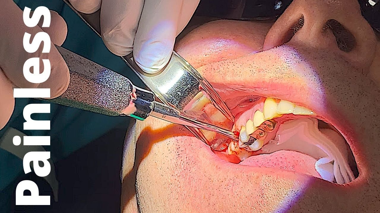 ⁣Tooth Extraction in Under 30 seconds - Pain Free Palatal Anesthesia