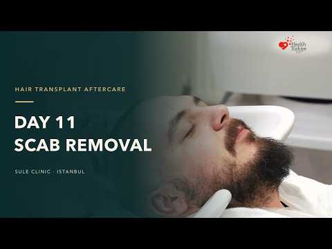 Day 11 Scab Removal After Hair Transplant | Recovery Guide
