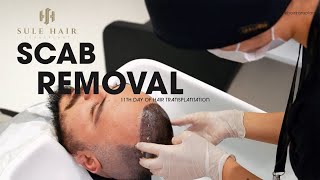 Perfecting Scab Removal On Day 11 Post-Hair Transplant Guide By Sule Hair Clinic