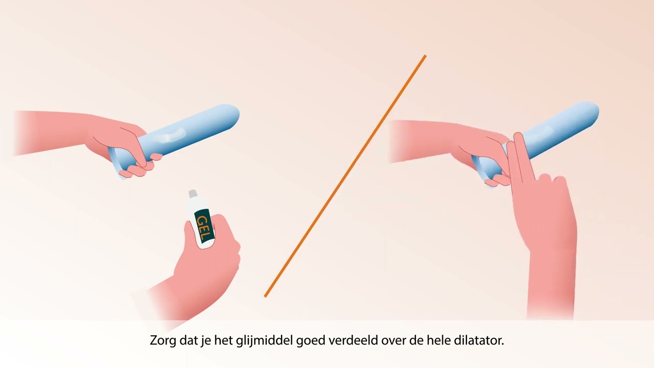 Dilateren en spoelen bij vaginaplastiek