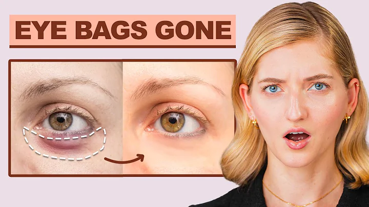 I'm Shocked! This ONE Acupressure Point Makes Eye Bags Disappear (Try It Now!)
