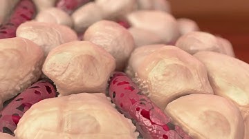 How Histotripsy Works