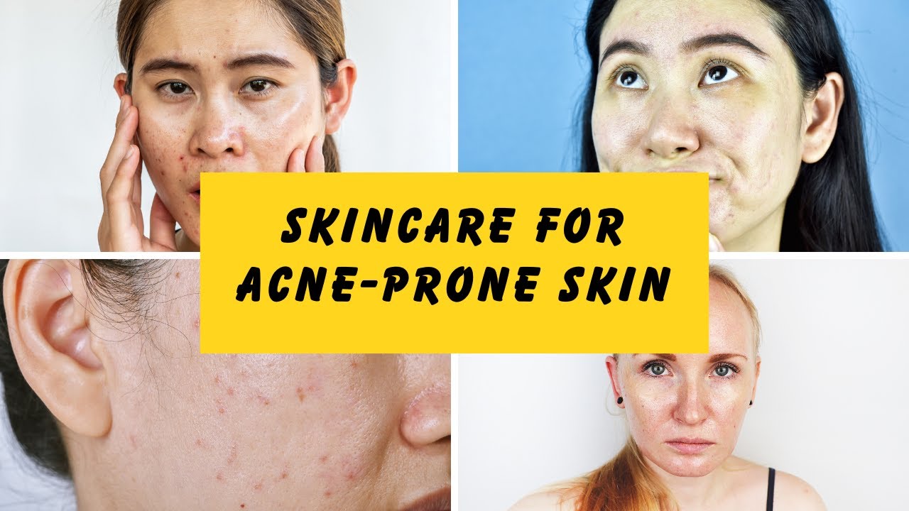 Acne-Prone Skin? Watch This Skincare Guide! | #skincareroutine # ...