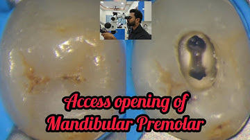 Access opening of Mandibular Premolar step by step demonstration #Rct for beginners #dental lectures
