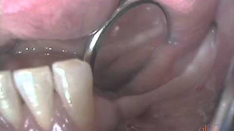 CV-08 Staged Treatment of a Thin Posterior Mandibular Ridge with Block Bone Grafting PREVIEW
