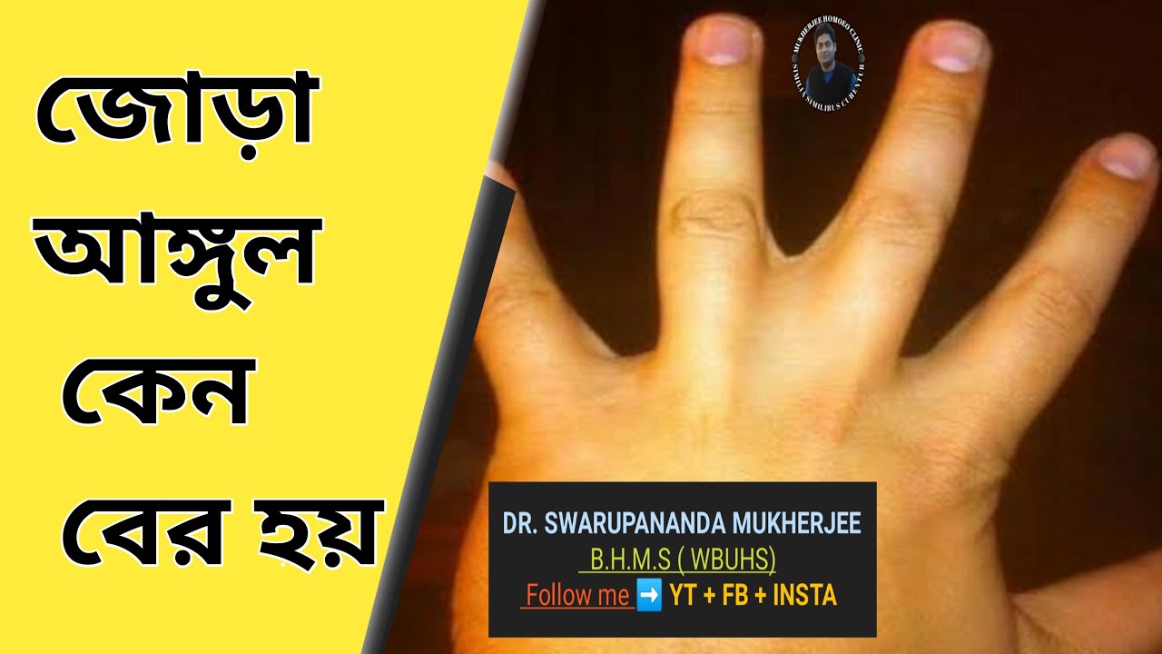 what-causes-webbed-fingers-homoeopathy-drswarupanandamukherjee