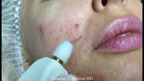 ACTIVE ACNE TREATED WITH PLEXR PLASMSA | Plexr Plus