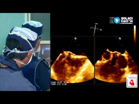 Video: ¿Por qué se cierra el foramen oval?