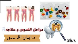 تخلص نهائياً من تسوس الاسنان و آلامه !(مراحل التسوس و علاجه) #الدكتورة_ايمان_الاسدي