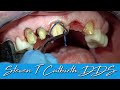 Dental Retraction Cord Placement - Dental Minute with Steven T. Cutbirth, DDS