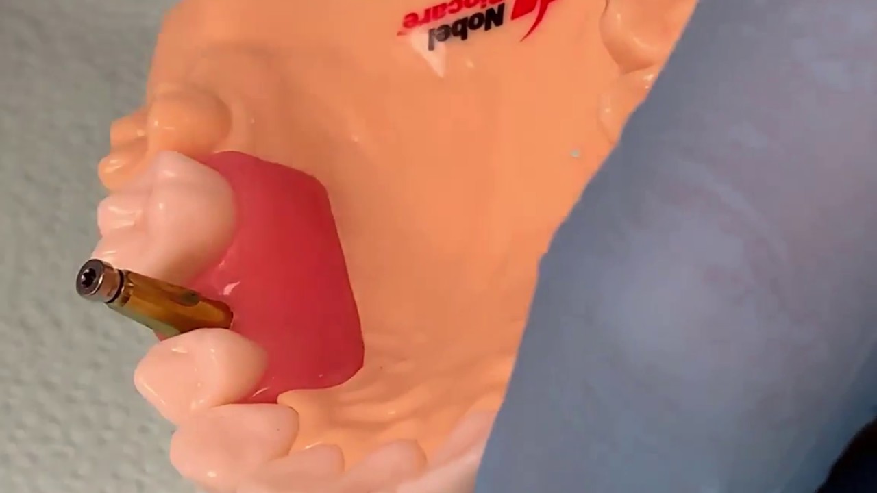 Implant Level Impression - Closed Tray Technique