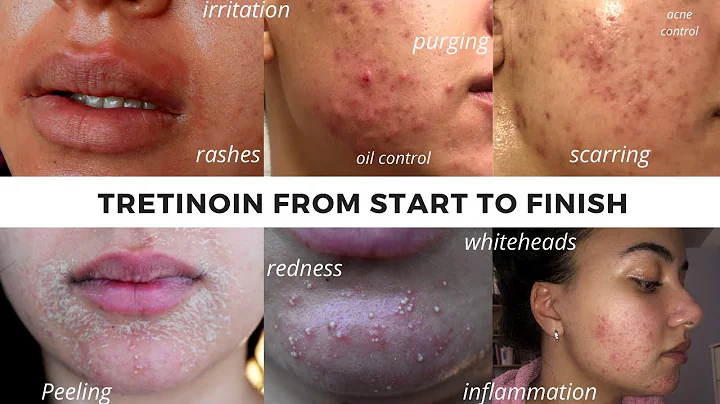 TRETINOIN BEFORE AND AFTER | FULL TRETINOIN EXPERIENCE my journey from start to end- Adult Acne.