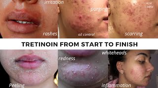 TRETINOIN BEFORE AND AFTER | FULL TRETINOIN EXPERIENCE my journey from start to end- Adult Acne.