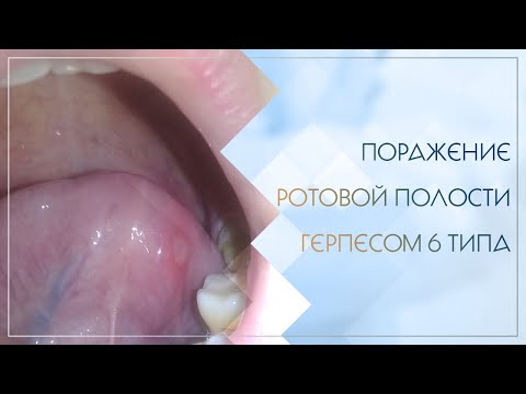 👄 Поражение ротовой полости герпесом 6 типа. Клинический случай №50