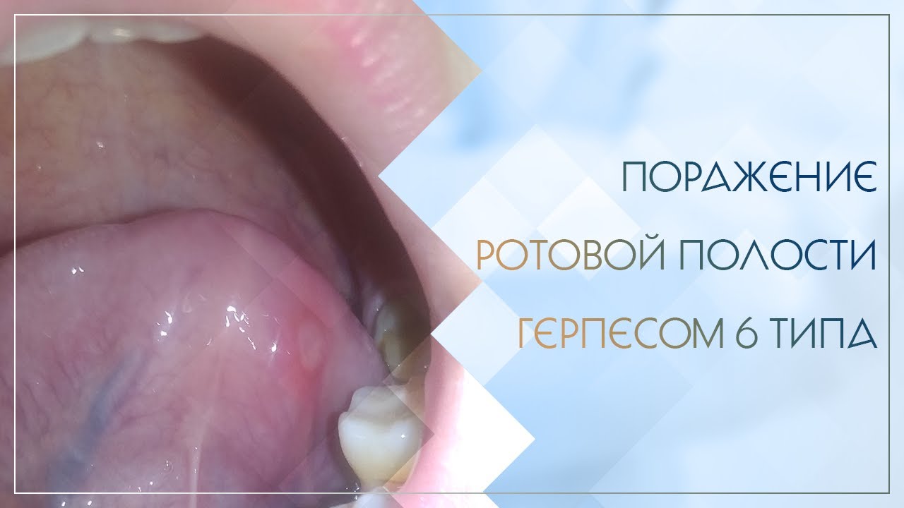 👄 Поражение ротовой полости герпесом 6 типа. Клинический случай №50 ...