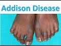 Addison Disease