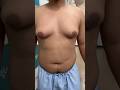 Gyno grade 2 - Patient story #shorts