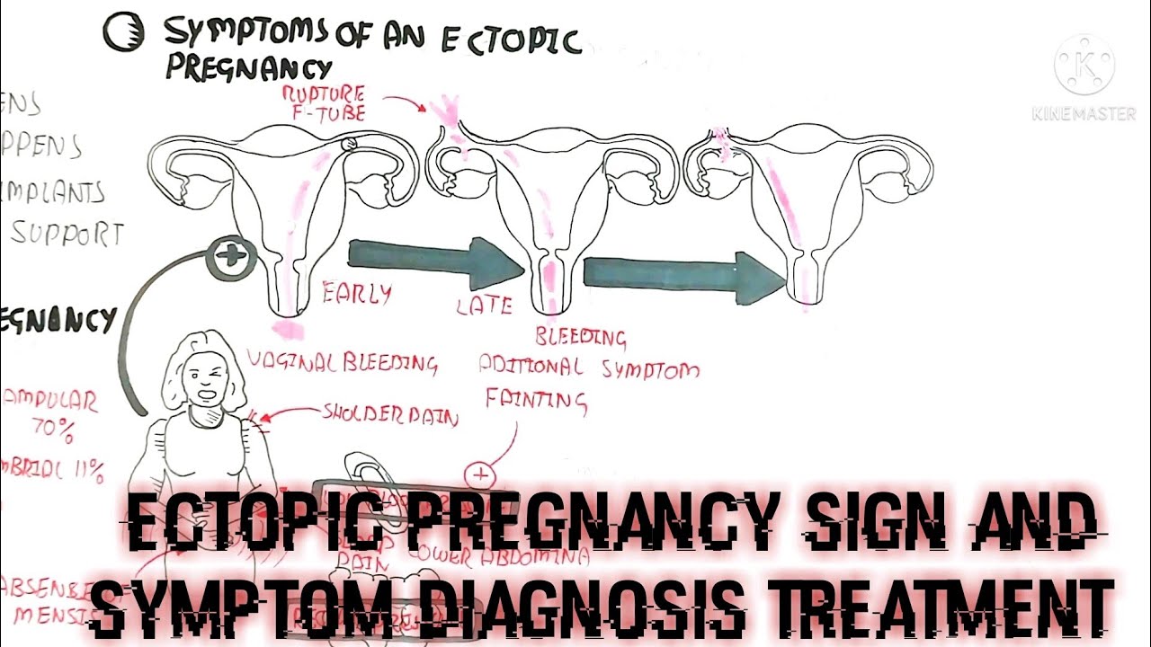 Ectopic Pregnancy/Sign And Symptom/Diagnosis/Treatment. Overview ...