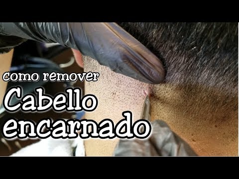 Vídeo: Cabello Encarnado: En El Cuero Cabelludo