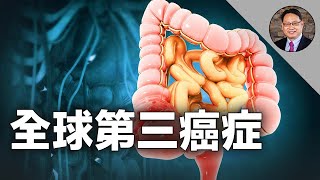 😨亞洲兩國上榜!大腸直腸癌發生率及死亡率真相及如何預防