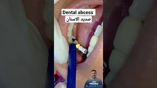 صديد الاسنان || Dental abcess|| दंत फोड़ा||牙周脓肿||absceso dental