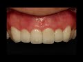 English dentist _ Before &amp;  After Zirconia Crown, Laminate