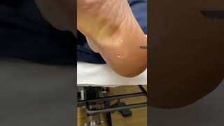 Dive Into The World Of Podiatry With Australia's Finest, As We Tackle Corn Removal. How Painful Is I