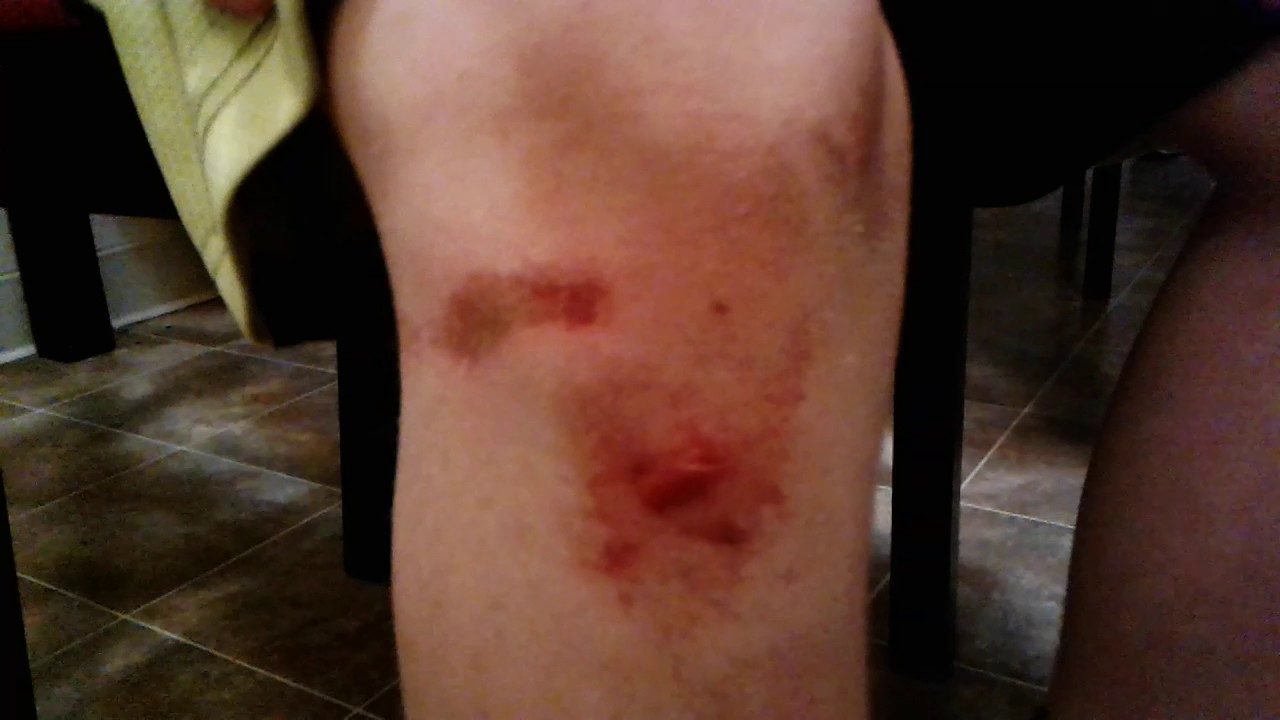 Bloody knee injury... - YouTube