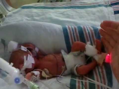 Our 25 week, one lb 6 ounce, micro-preemie success story - YouTube