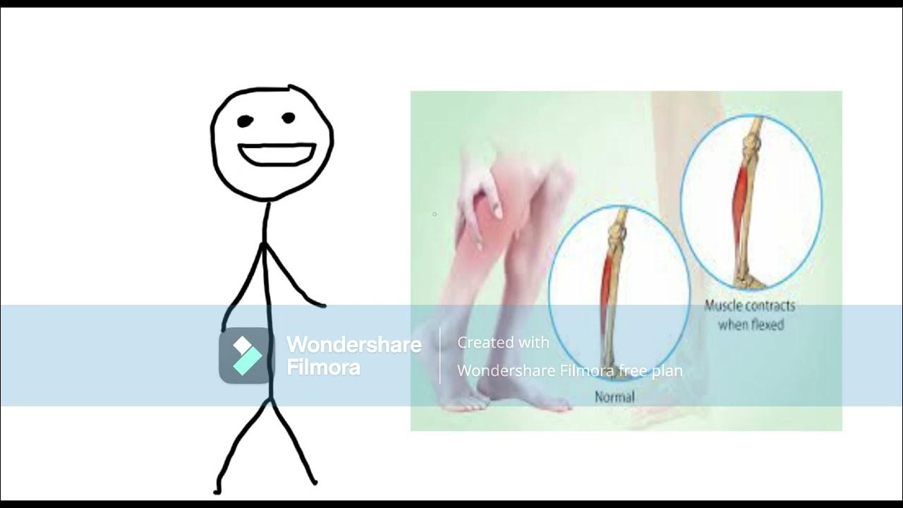 How to get rid of a charley horse YouTube