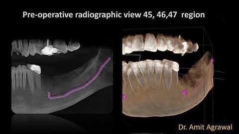 Ridge Split with Piezosurgery for Dental Implant