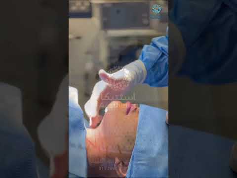 وداع ا للغلوغ إزالة اللغلوغ مع الاستشاري البراء في عيادات أسثتيكا