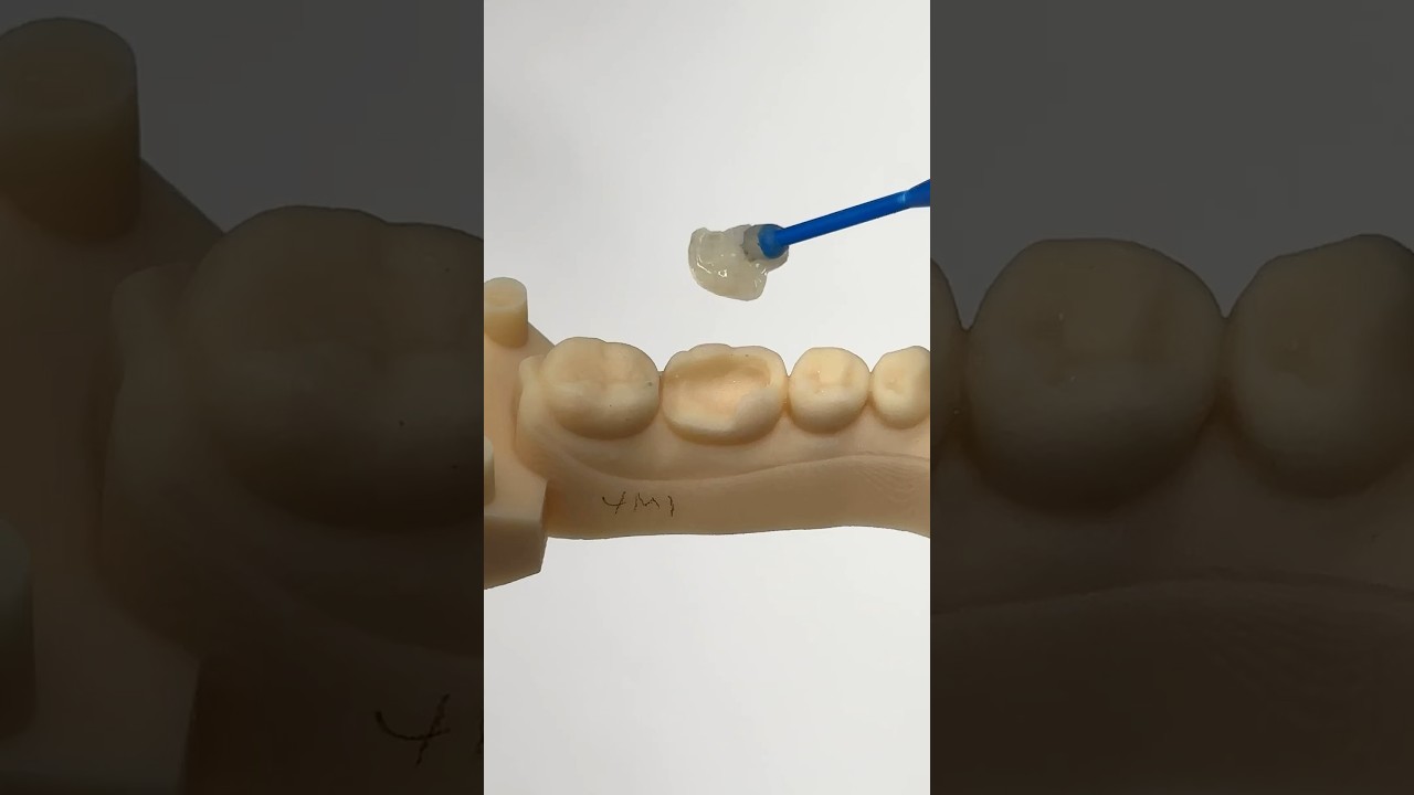 Posterior Amber Press Inlay/Onlay 