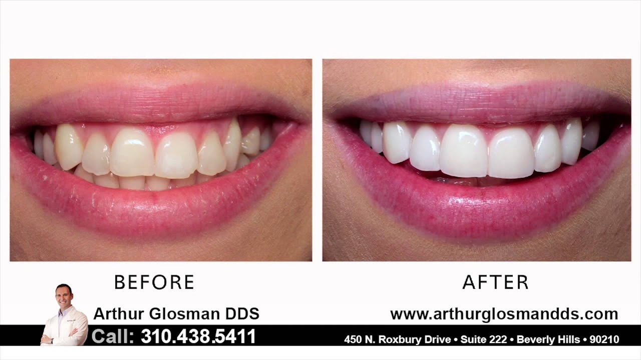 Beverly Hills Cosmetic Dentist Arthur Glosman DDS YouTube