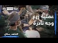 عملية زرع وجه نادرة 