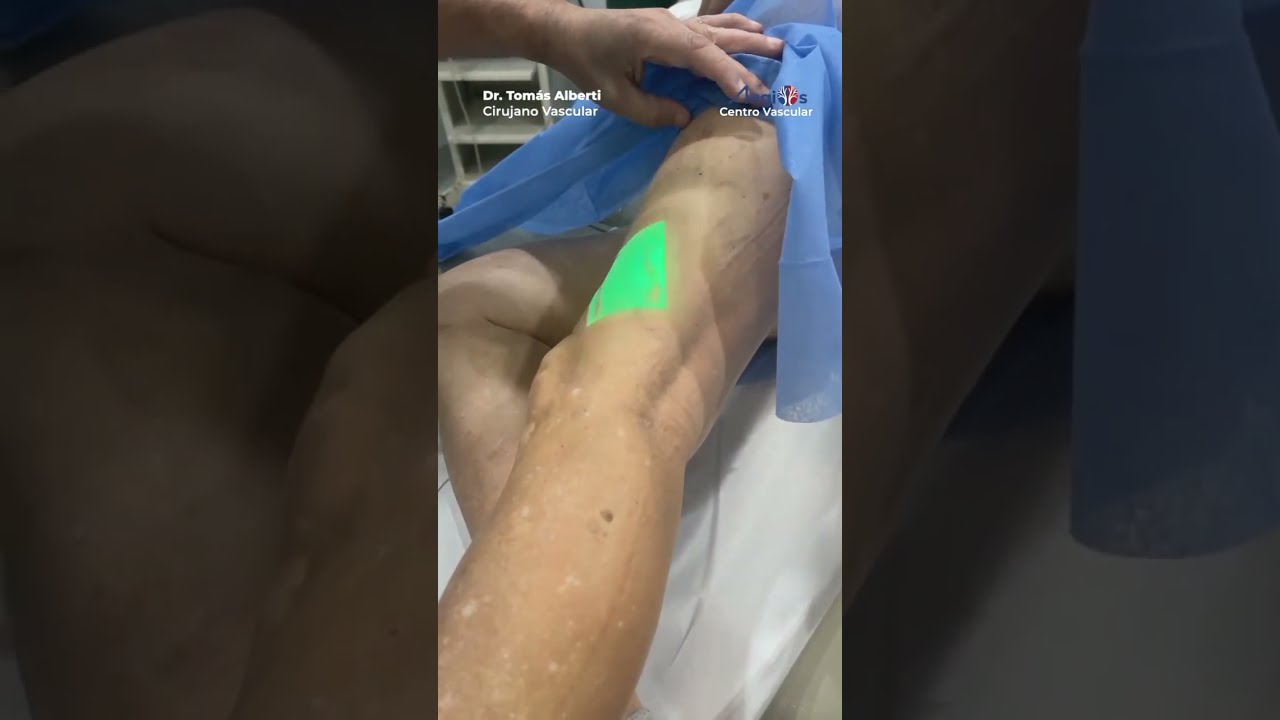 Planificación de un procedimiento de ESCLEROTERAPIA para arañas vasculares