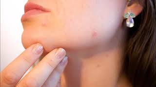 Formen der Akne Acne aestivalis Mallorca Sommerakne