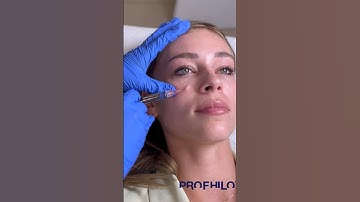 Profilo. The best injectable moisturiser for bright radiant skin #cosmeticsurgery #lipfiller