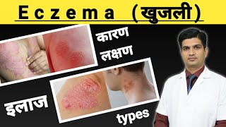 Eczema Treatment | Eczema kya hota hai