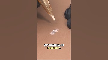 💉 Long vs. Short Movements  using a low speed 🤔   #pmu