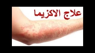 تخلصوا من الاكزيما و الى الابد بمواد طبيعيه وأمنه