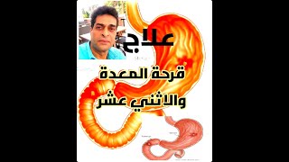 علاج قرحة المعدة والاثنى عشر بالتفصيل الكامل.